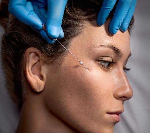 The Art of Microneedling: A Natural Approach to Combatting Acne Scars
